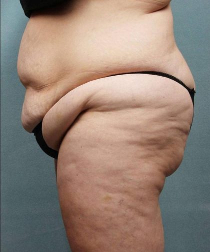 Weight Loss Before & After Patient #9172