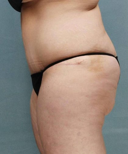 Weight Loss Before & After Patient #9172