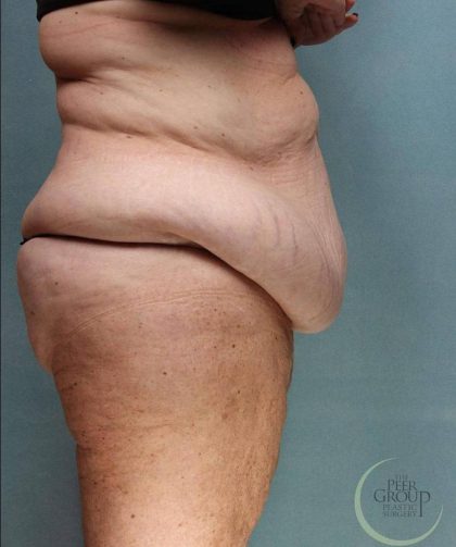 Weight Loss Before & After Patient #9173