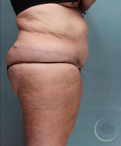 Weight Loss Before & After Patient #9173