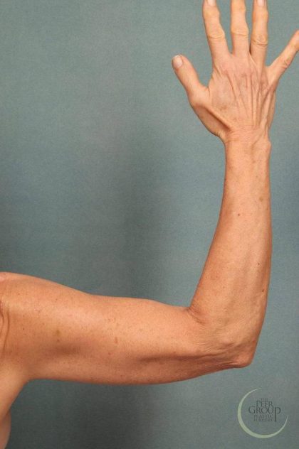 Arm Lift Before & After Patient #9174