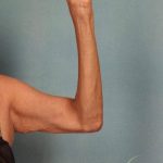 Arm Lift Before & After Patient #9175