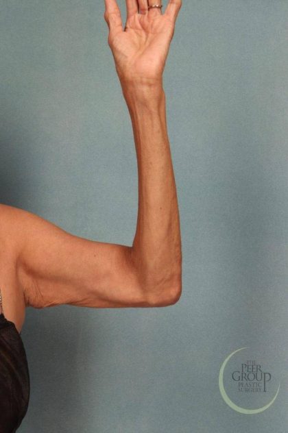 Arm Lift Before & After Patient #9175