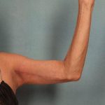 Arm Lift Before & After Patient #9175