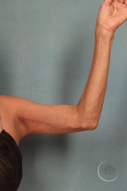 Arm Lift Before & After Patient #9175