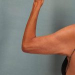 Arm Lift Before & After Patient #9175