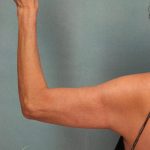 Arm Lift Before & After Patient #9175