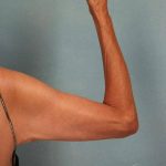 Arm Lift Before & After Patient #9175