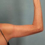 Arm Lift Before & After Patient #9175