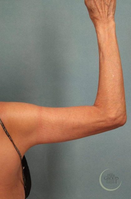Arm Lift Before & After Patient #9175