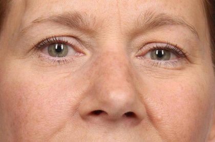 Blepharoplasty Before & After Patient #8983