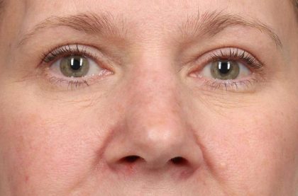 Blepharoplasty Before & After Patient #8983