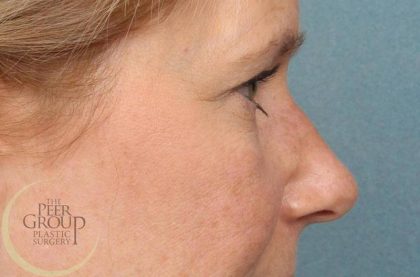 Blepharoplasty Before & After Patient #8983