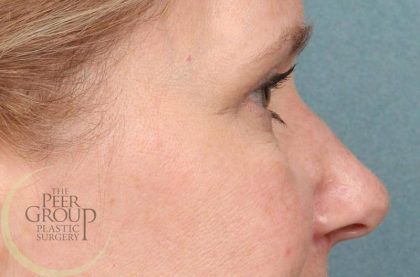 Blepharoplasty Before & After Patient #8983