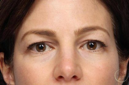 Blepharoplasty Before & After Patient #8982