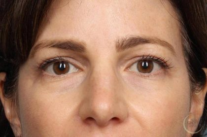 Blepharoplasty Before & After Patient #8982