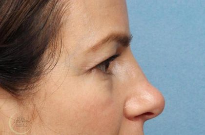 Blepharoplasty Before & After Patient #8982