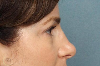 Blepharoplasty Before & After Patient #8982