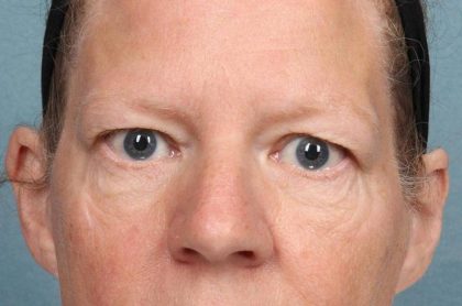 Blepharoplasty Before & After Patient #8981