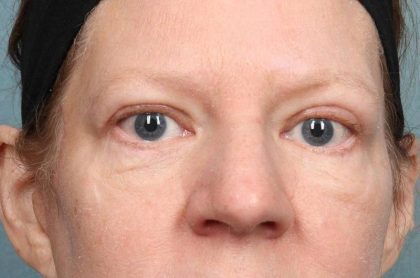 Blepharoplasty Before & After Patient #8981
