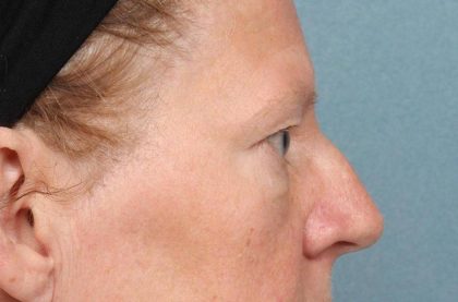 Blepharoplasty Before & After Patient #8981