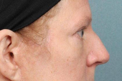 Blepharoplasty Before & After Patient #8981
