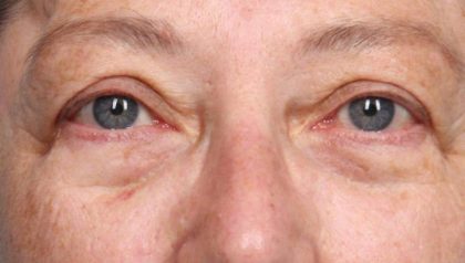 Blepharoplasty Before & After Patient #8980