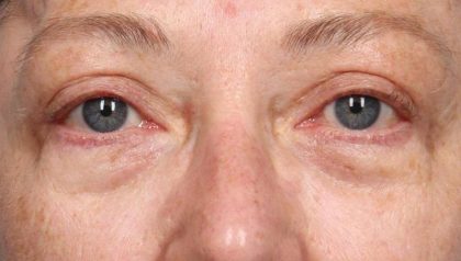 Blepharoplasty Before & After Patient #8980