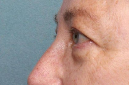 Blepharoplasty Before & After Patient #8980