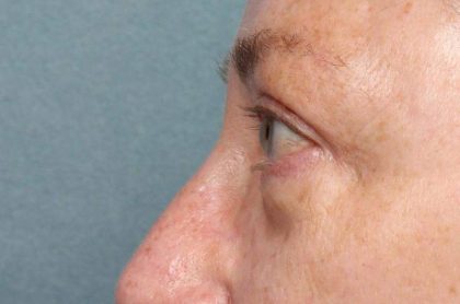 Blepharoplasty Before & After Patient #8980