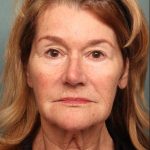 Botox Before & After Patient #9082