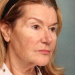 Botox Before & After Patient #9082