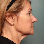 Botox Before & After Patient #9082