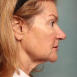 Botox Before & After Patient #9082