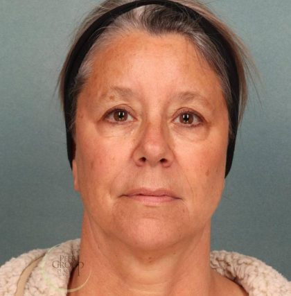 Botox Before & After Patient #9084