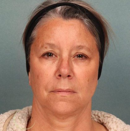 Botox Before & After Patient #9084