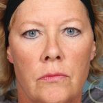 Botox Before & After Patient #9088