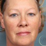 Botox Before & After Patient #9088
