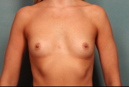 Breast Augmentation Before & After Patient #8652