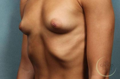 Breast Augmentation Before & After Patient #8653