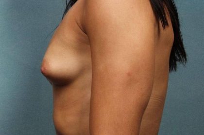Breast Augmentation Before & After Patient #8653