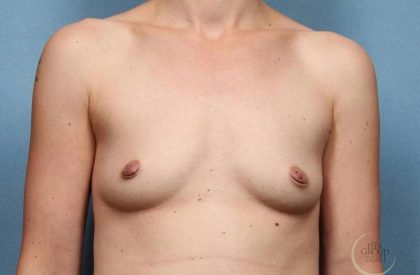 Breast Augmentation Before & After Patient #8654
