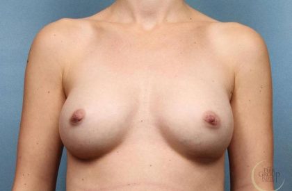Breast Augmentation Before & After Patient #8654