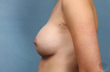 Breast Augmentation Before & After Patient #8654