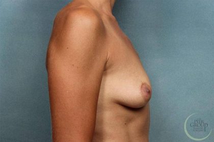 Breast Augmentation Before & After Patient #8657
