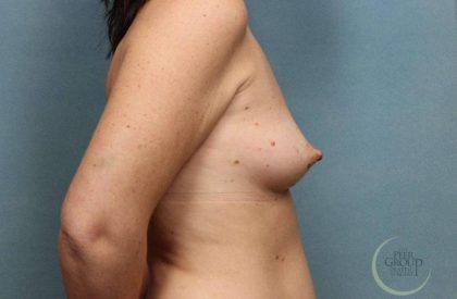 Breast Augmentation Before & After Patient #8659