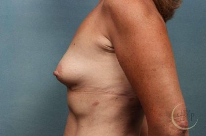Breast Augmentation Before & After Patient #8661