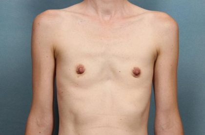 Breast Augmentation Before & After Patient #8547