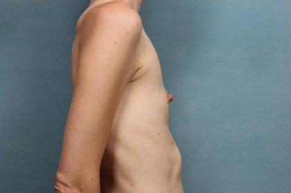 Breast Augmentation Before & After Patient #8547