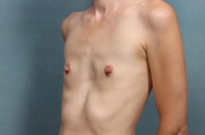Breast Augmentation Before & After Patient #8547